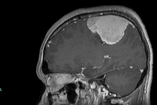 Complex Brain Tumor Removed Successfully, Restoring Hope