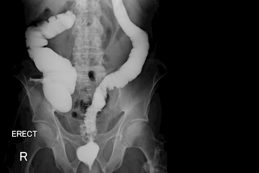 Restoring Normal Bowel Function Through Advanced Colorectal Surgery at Almana Hospital Jubail